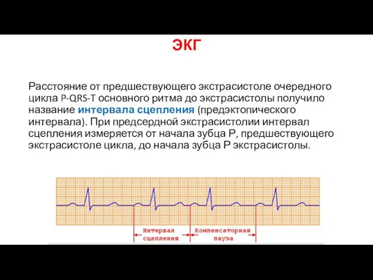 ЭКГ Расстояние от предшествующего экстрасистоле очередного цикла P-QRS-T основного ритма до