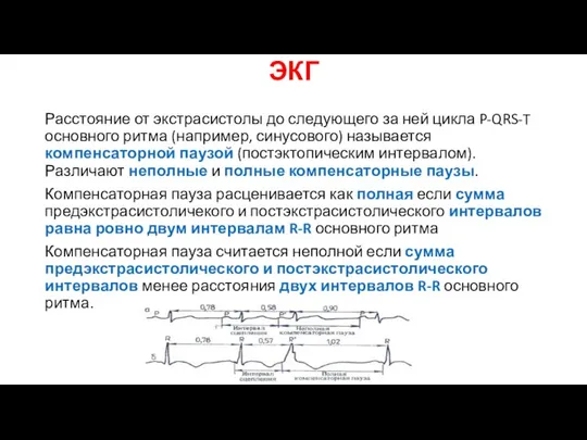 ЭКГ Расстояние от экстрасистолы до следующего за ней цикла P-QRS-T основного