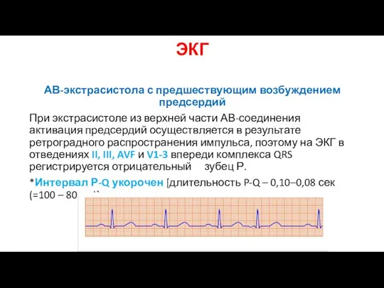 ЭКГ АВ-экстрасистола с предшествующим возбуждением предсердий При экстрасистоле из верхней части