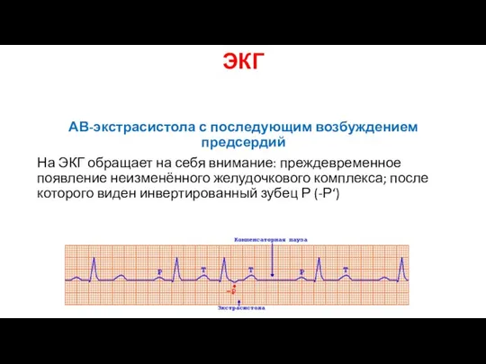 ЭКГ АВ-экстрасистола с последующим возбуждением предсердий На ЭКГ обращает на себя