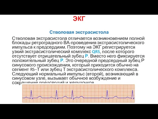 ЭКГ Стволовая экстрасистола Стволовая экстрасистола отличается возникновением полной блокады ретроградного ВА-проведения