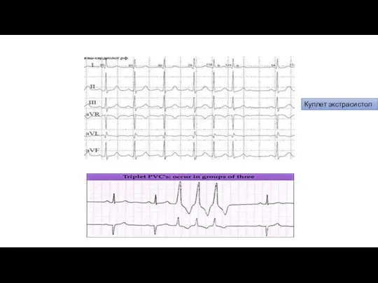 Куплет экстрасистол