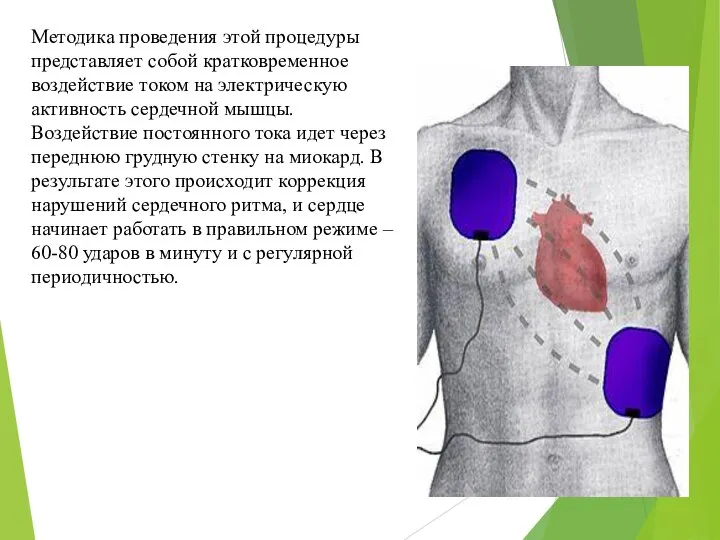 Методика проведения этой процедуры представляет собой кратковременное воздействие током на электрическую