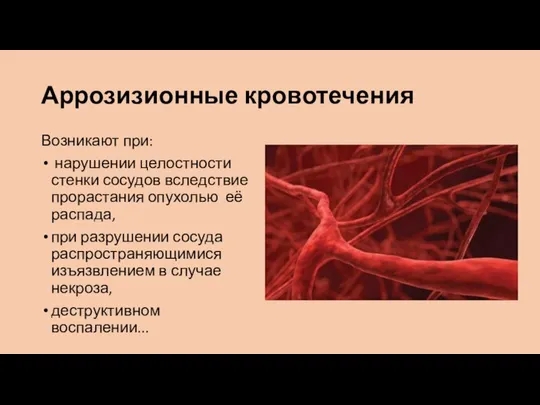 Аррозизионные кровотечения Возникают при: нарушении целостности стенки сосудов вследствие прорастания опухолью