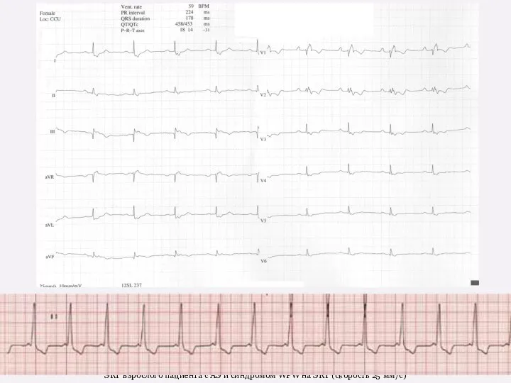 ЭКГ взрослого пациента с АЭ и синдромом WPW на ЭКГ (скорость 25 мм/с)