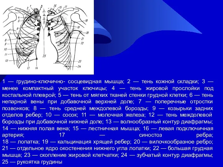 1 — грудино-ключично- сосцевидная мышца; 2 — тень кожной складки; 3