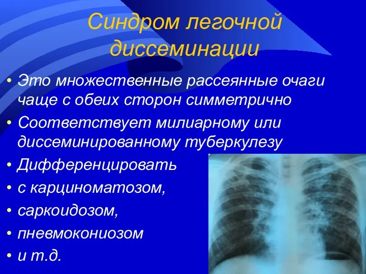 Синдром легочной диссеминации Это множественные рассеянные очаги чаще с обеих сторон