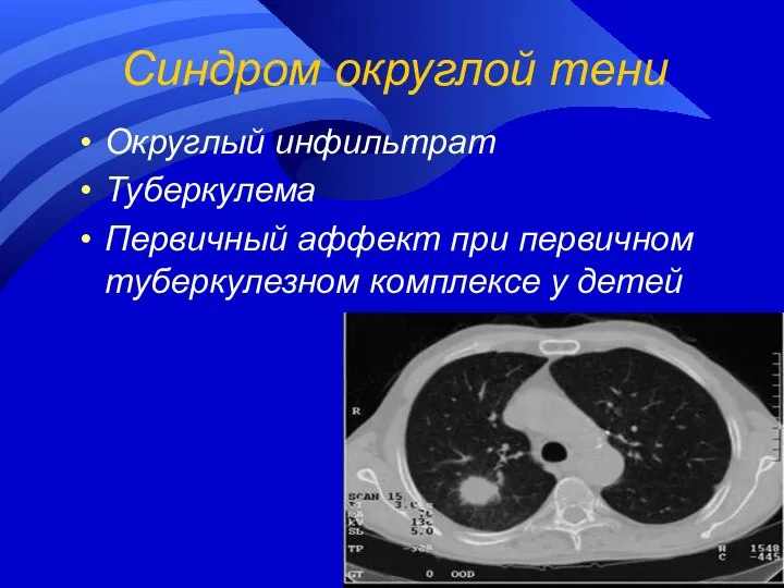 Синдром округлой тени Округлый инфильтрат Туберкулема Первичный аффект при первичном туберкулезном комплексе у детей