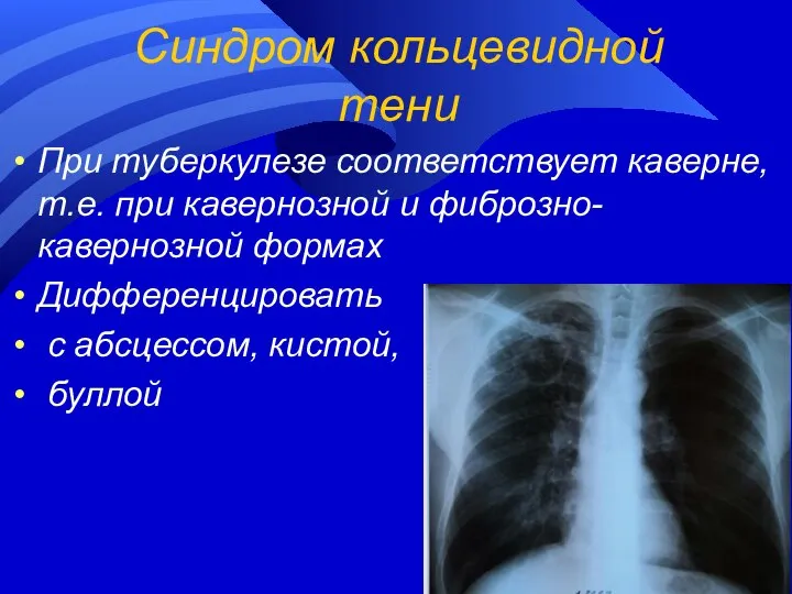 Синдром кольцевидной тени При туберкулезе соответствует каверне, т.е. при кавернозной и