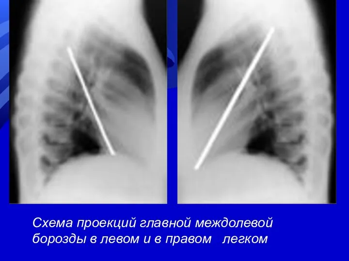 Схема проекций главной междолевой борозды в левом и в правом легком