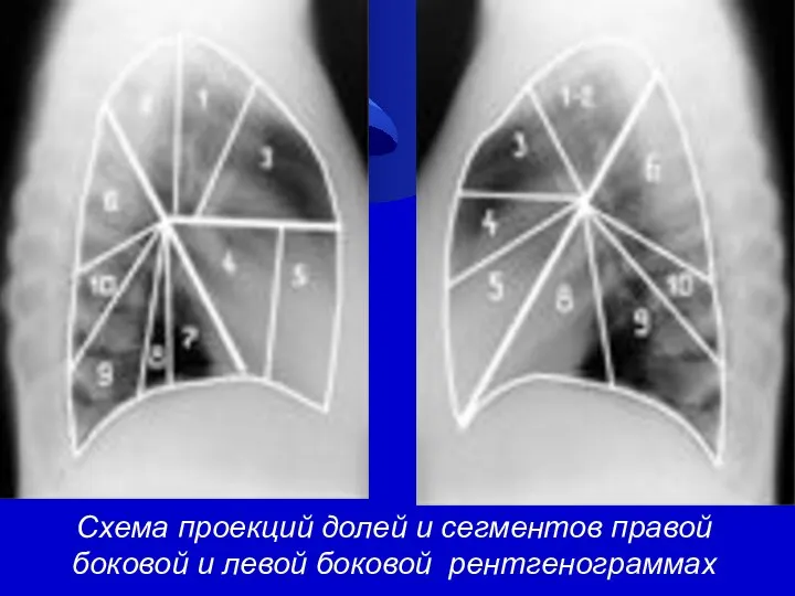 Схема проекций долей и сегментов правой боковой и левой боковой рентгенограммах