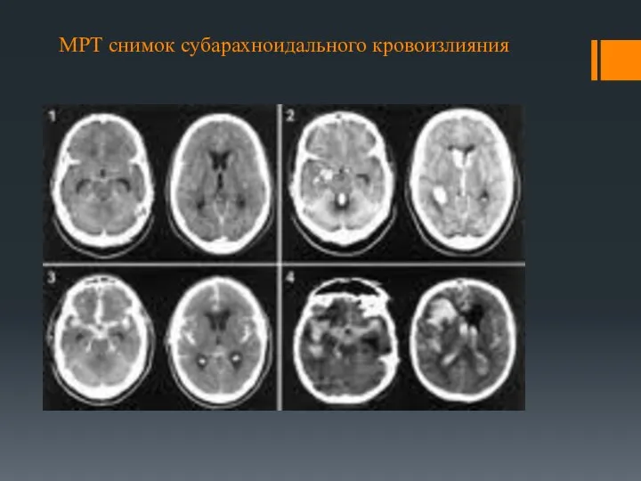 МРТ снимок субарахноидального кровоизлияния