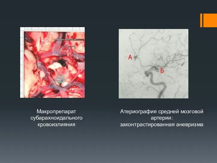 Атериография средней мозговой артерии: законтрастированная аневризма Макропрепарат субарахноидального кровоизлияния