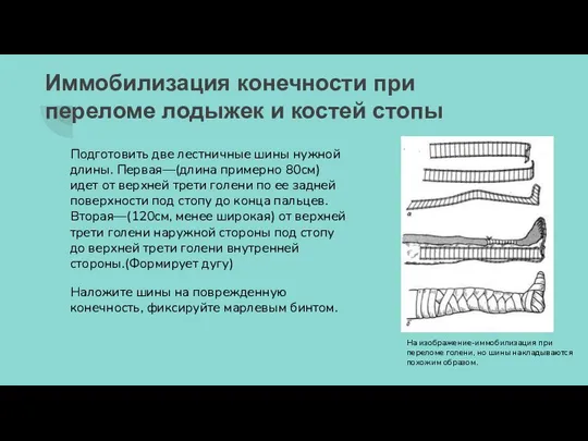 Иммобилизация конечности при переломе лодыжек и костей стопы Подготовить две лестничные