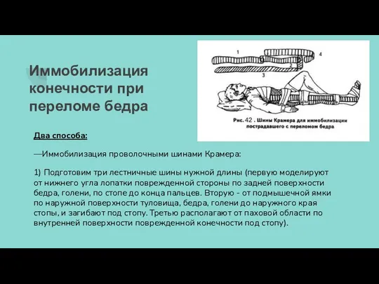 Иммобилизация конечности при переломе бедра Два способа: —Иммобилизация проволочными шинами Крамера: