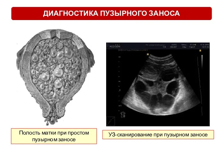 Полость матки при простом пузырном заносе УЗ-сканирование при пузырном заносе