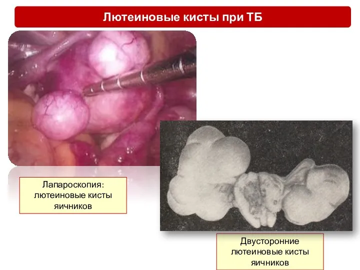 Двусторонние лютеиновые кисты яичников Лапароскопия: лютеиновые кисты яичников