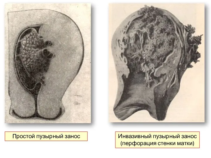 Простой пузырный занос Инвазивный пузырный занос (перфорация стенки матки)