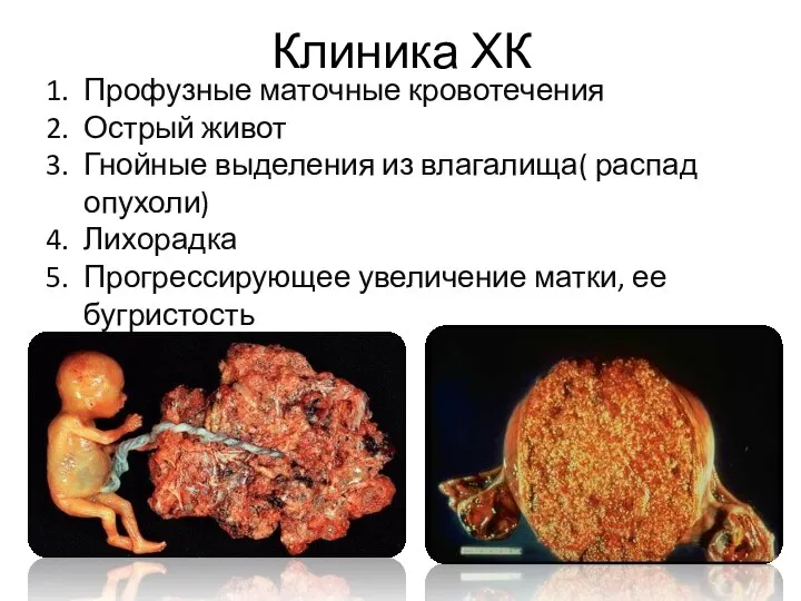 Клиника ХК Профузные маточные кровотечения Острый живот Гнойные выделения из влагалища(