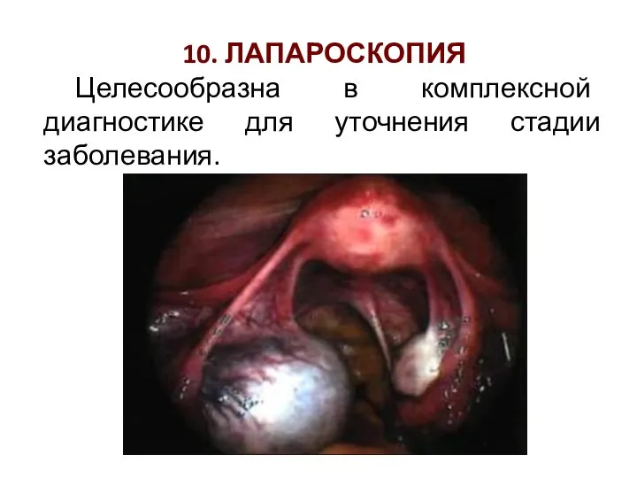 10. ЛАПАРОСКОПИЯ Целесообразна в комплексной диагностике для уточнения стадии заболевания.