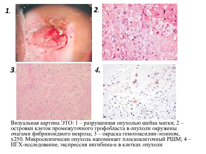 Визуальная картина ЭТО: 1 – разрушенная опухолью шейка матки; 2 –