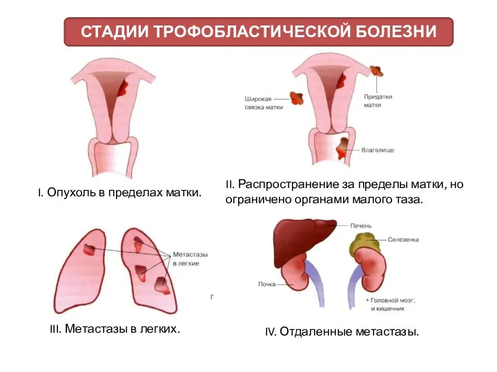 I. Опухоль в пределах матки. II. Распространение за пределы матки, но