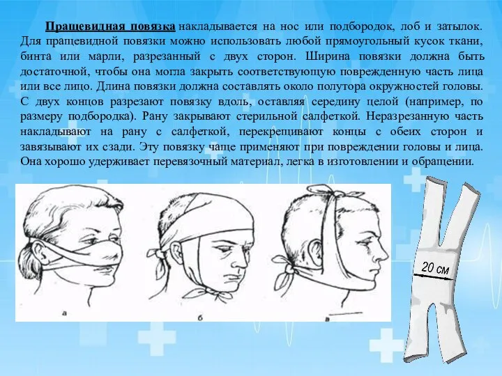 Пращевидная повязка накладывается на нос или подбородок, лоб и затылок. Для