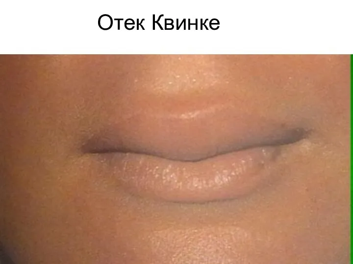 Отек Квинке