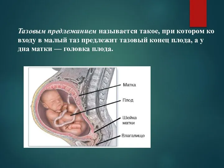 Тазовым предлежанием называется такое, при котором ко входу в малый таз