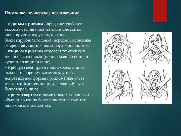 Наружное акушерское исследование. – первым приемом определяется более высокое стояние дна