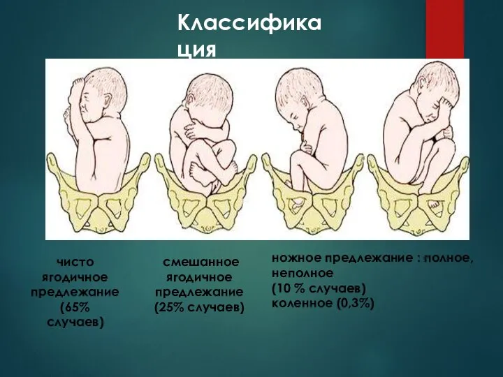 смешанное ягодичное предлежание (25% случаев) чисто ягодичное предлежание (65% случаев) ножное