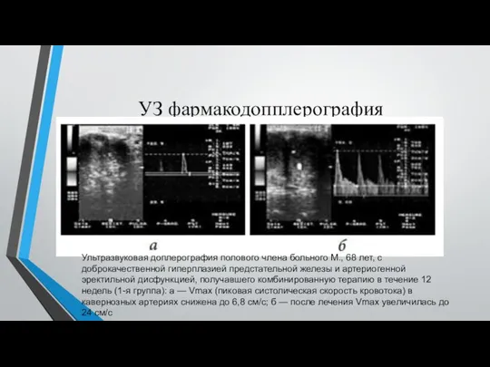 УЗ фармакодопплерография Ультразвуковая доплерография полового члена больного М., 68 лет, с