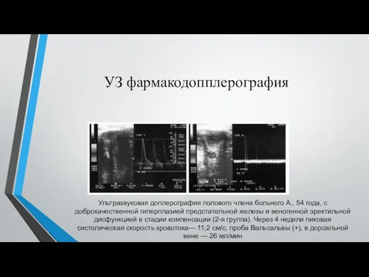 УЗ фармакодопплерография Ультразвуковая доплерография полового члена больного А., 54 года, с