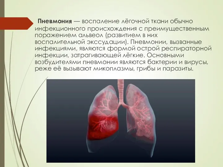 Пневмония — воспаление лёгочной ткани обычно инфекционного происхождения с преимущественным поражением