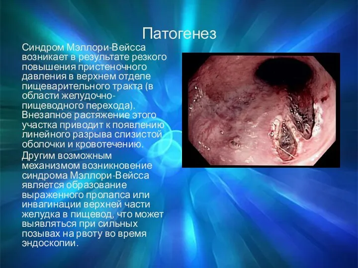 Патогенез Синдром Мэллори-Вейсса возникает в результате резкого повышения пристеночного давления в