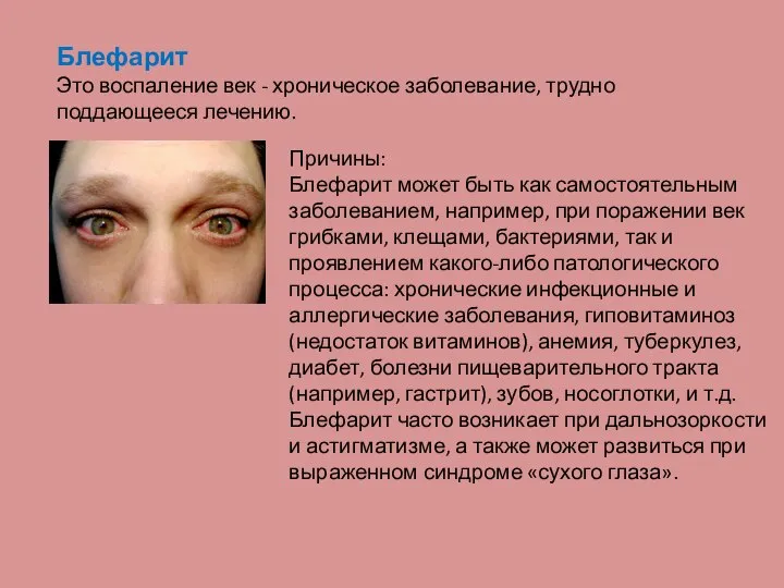 Блефарит Это воспаление век - хроническое заболевание, трудно поддающееся лечению. Причины: