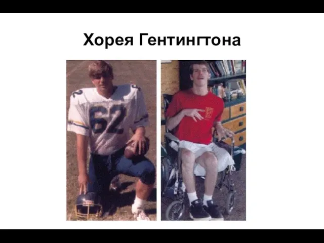 Хорея Гентингтона