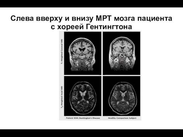 Слева вверху и внизу МРТ мозга пациента с хореей Гентингтона