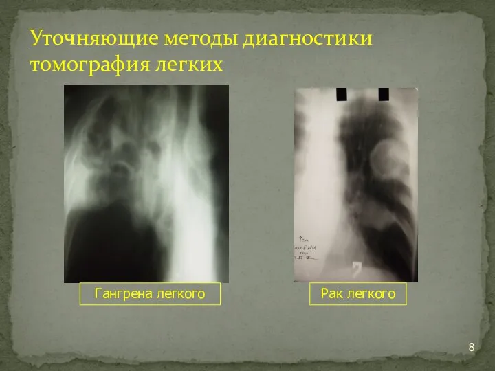 Уточняющие методы диагностики томография легких Гангрена легкого Рак легкого