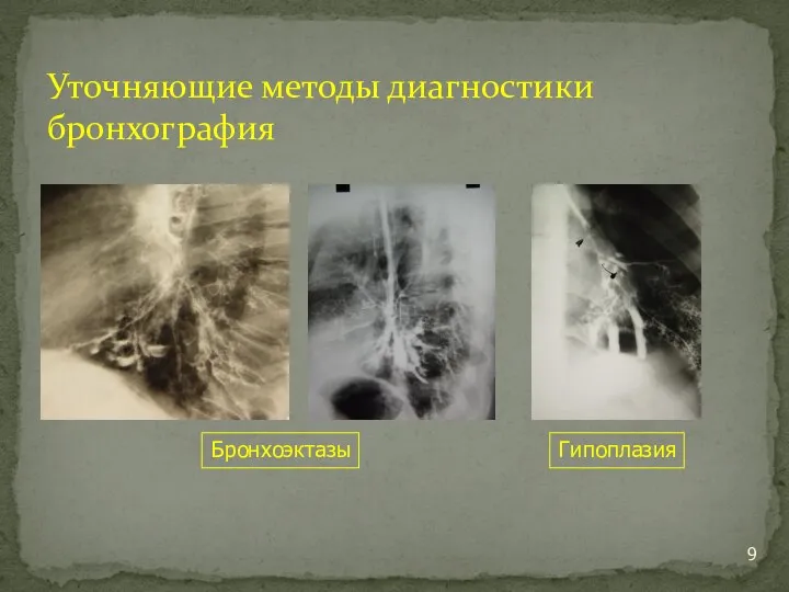 Уточняющие методы диагностики бронхография Бронхоэктазы Гипоплазия