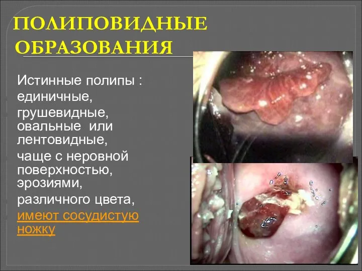 ПОЛИПОВИДНЫЕ ОБРАЗОВАНИЯ Истинные полипы : единичные, грушевидные, овальные или лентовидные, чаще