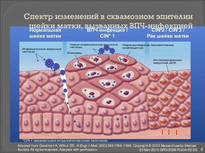 Спектр изменений в сквамозном эпителии шейки матки, вызванных ВПЧ-инфекцией Нормальная шейка