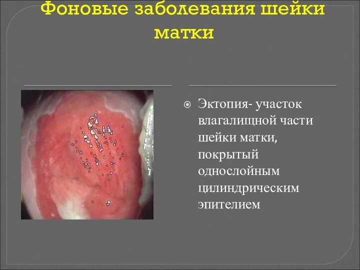 Фоновые заболевания шейки матки Эктопия- участок влагалищной части шейки матки, покрытый однослойным цилиндрическим эпителием