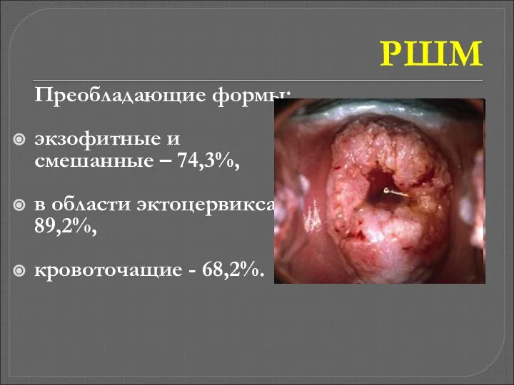 РШМ Преобладающие формы: экзофитные и смешанные – 74,3%, в области эктоцервикса - 89,2%, кровоточащие - 68,2%.