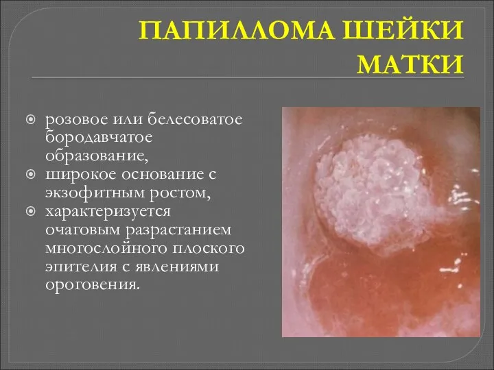 ПАПИЛЛОМА ШЕЙКИ МАТКИ розовое или белесоватое бородавчатое образование, широкое основание с