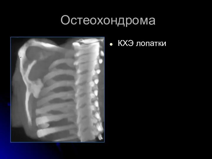 Остеохондрома КХЭ лопатки