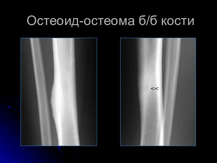 Остеоид-остеома б/б кости