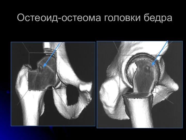 Остеоид-остеома головки бедра