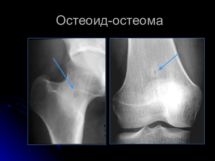 Остеоид-остеома