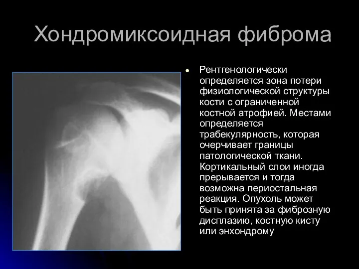 Хондромиксоидная фиброма Рентгенологически определяется зона потери физиологической структуры кости с ограниченной